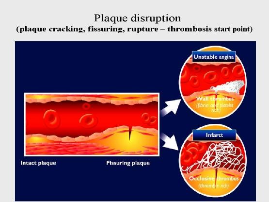 Figure (16): Fissuring, tear or rupture of the vulnerable plaque exposing the lipid core to the blood.