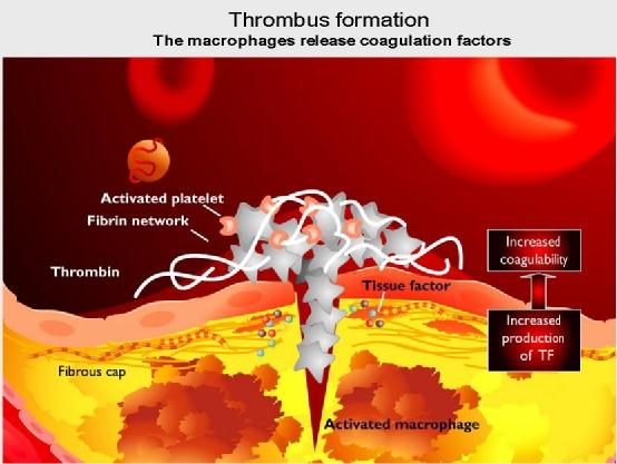 Figure (17): Plaque fissuring or rupture will expose the strongly thrombogenic lipid core and the extracellular matrix to the blood. Platelet and fibrin thrombi are formed at site of fissuring.