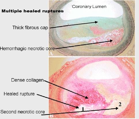 Figure (18): Rupture of the ASO plaque and thrombus formation is a recurrent and silent process in the majority of cases and is followed by healing of the ruptured plaque.