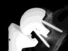Complications in Reverse Shoulder Arthroplasty Radiolucencies* Instability* Infection Glenoid loosening* Hematoma Humerus fracture (in op) Acromio/Scap fracture