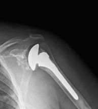 Longevity of a total and reverse shoulder prosthesis largely depends on correct positioning and fixation of the glenoid component.