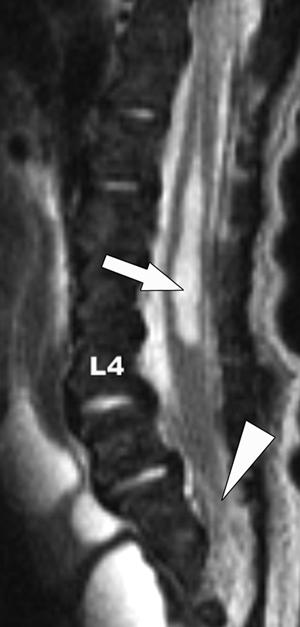 level. Fig. 2 Syrinx and tethered cord in 1-week-old girl with imperforate anus and scoliosis.