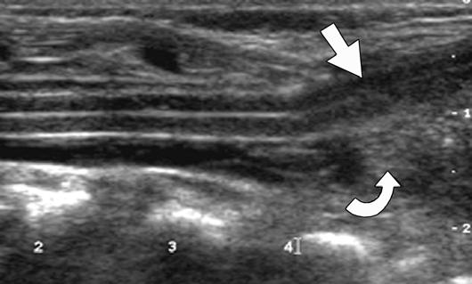 aspect of thoracolumbar spinal cord. Conus is tethered to mass at L3 L4 disk space (arrow).