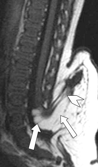4 Lipomyelomeningocele in 1-day-old girl with soft-tissue swelling on lower back.
