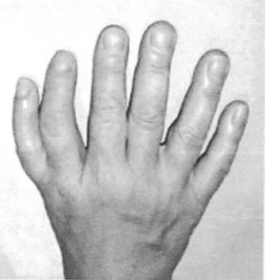 10 (c) Fig. 5.2 shows the hand of a person who suffers from a mutation that results in people having more than five digits on each hand (polydactyly). Fig. 5.2 The mutation that results in this condition is dominant.