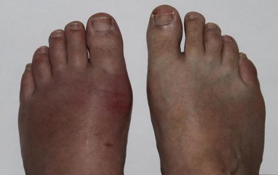 OpenStax-CNX module: m44811 4 Figure 3: Gout causes the inammation visible in this person's left big toe joint.