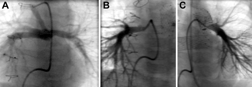 1888 HONJO ET AL Ann Thorac Surg OUTCOMES WITH HYBRID VERSUS NORWOOD STRATEGY 2009;87:1885 93 Fig 2. Angiograms at pre stage 2 cardiac catheterization in hybrid and Norwood groups.