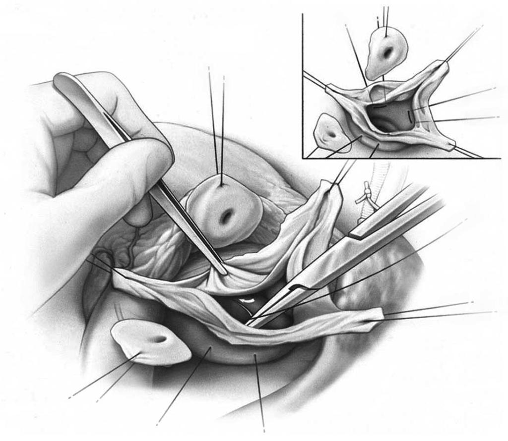 Valve-sparing aortic root replacement 265 Figure 6 Three horizontal mattress sutures of 2-0 Tevdek are placed from within the left