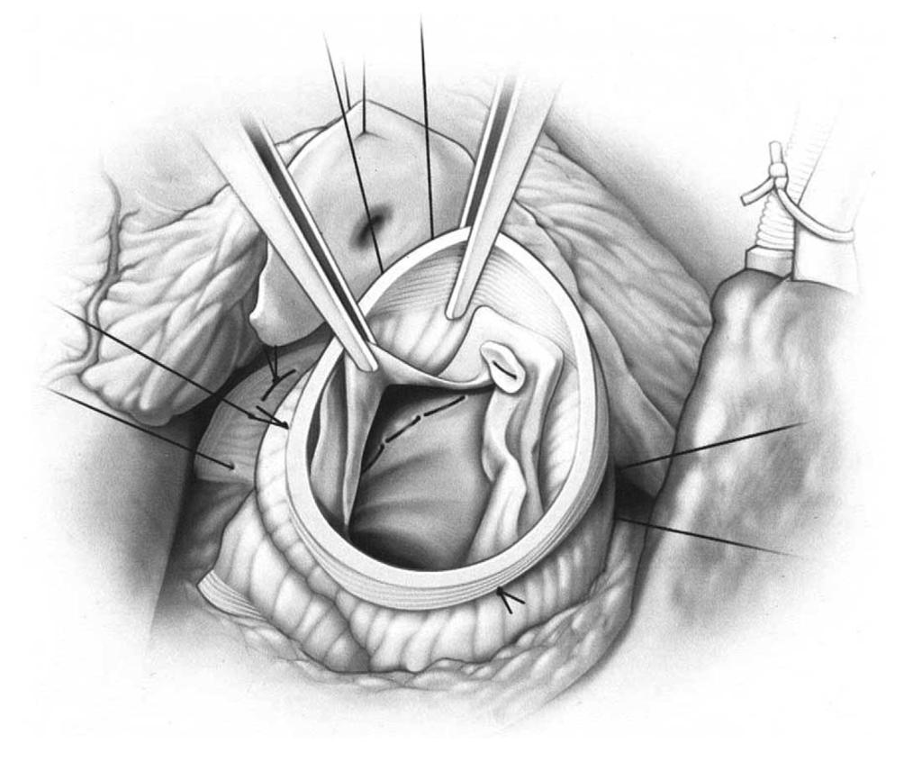 Valve-sparing aortic root replacement 267 Figure 8 At this point, the root is now oriented within the graft.