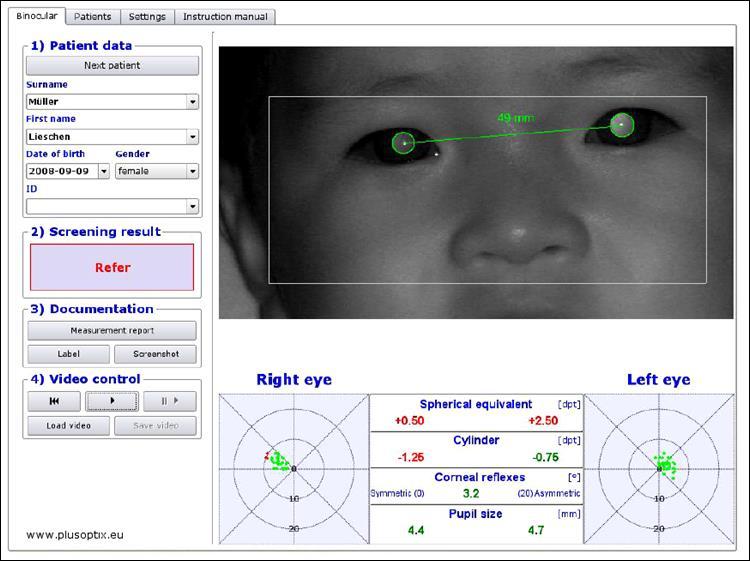 Example of a Plusoptix S09 Measurement Screen Refractive Errors identifies possible hyperopia/farsightedness (+) and