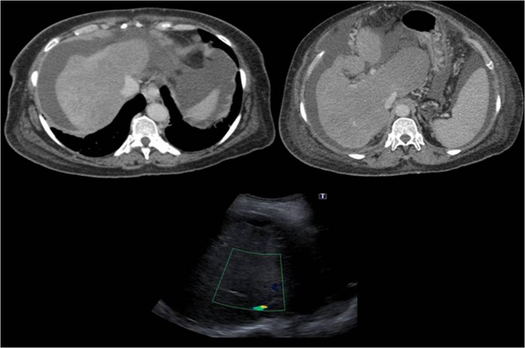 Fig. 2: Budd-Chiari Syndrome in chronic phase. Images A: and B: Abdominopelvic CT with intravenous contrast. Image C: Ultrasound.