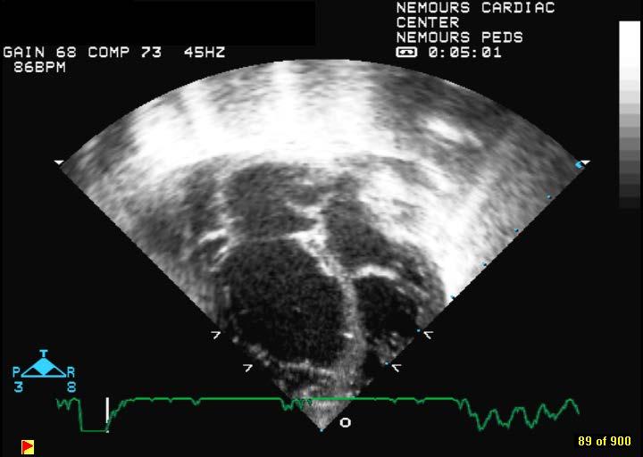Ventricular dysfunction Ineffective LV filling due