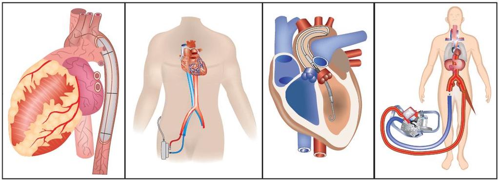 Circulatory support systems for cardiogenic shock after ACS can be distinguished by: the method of placement (i.e. percutaneous vs. surgical), the type of circulatory support (i.e. left ventricular, right ventricular, or biventricular pressure and/or volume unloading), whether they are combined with gas exchange.