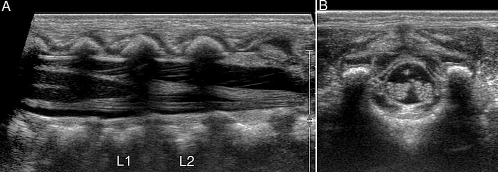 - 2009 ORIGINAL ARTICLES Figure 2. Sonographic views of normal distal spinal cord and conus medullaris in a healthy term neonate.