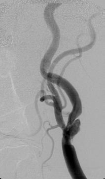 Carotid Stenosis Prevalence >50%: 2-8% >80%: 1-2% With CAD 10-30% With PAD 25-50% Stenosis Annual