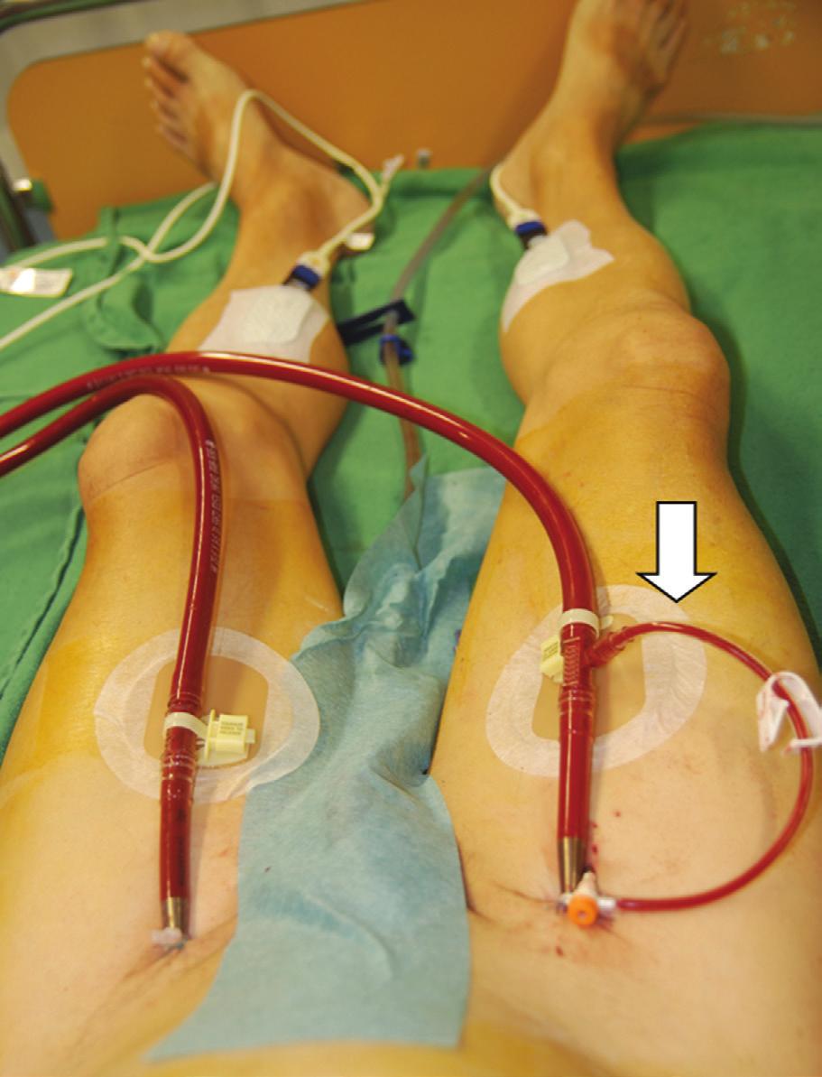 321 Figure 1 - Correct cannula placement with a distal leg perfusion system for the right femoral artery (arrow). METHODS Patients.