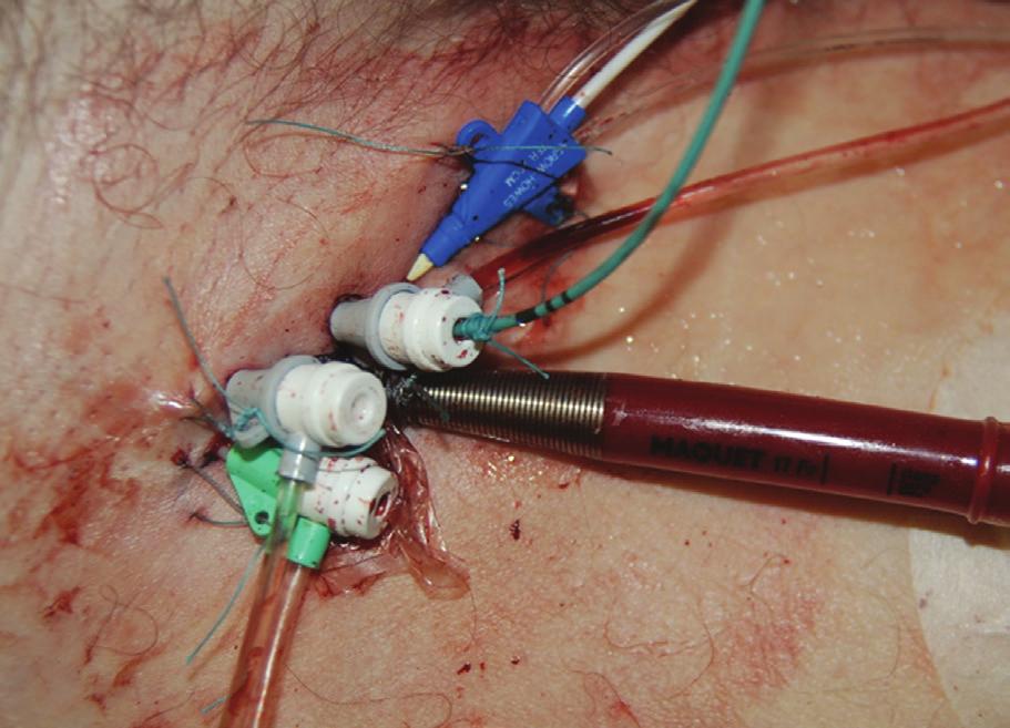 ECMO cannulation cial to avoid disastrous ischemic complications. Clinical judgement, pulse palpation, and Doppler sonography of limb vessels serve the purpose well.