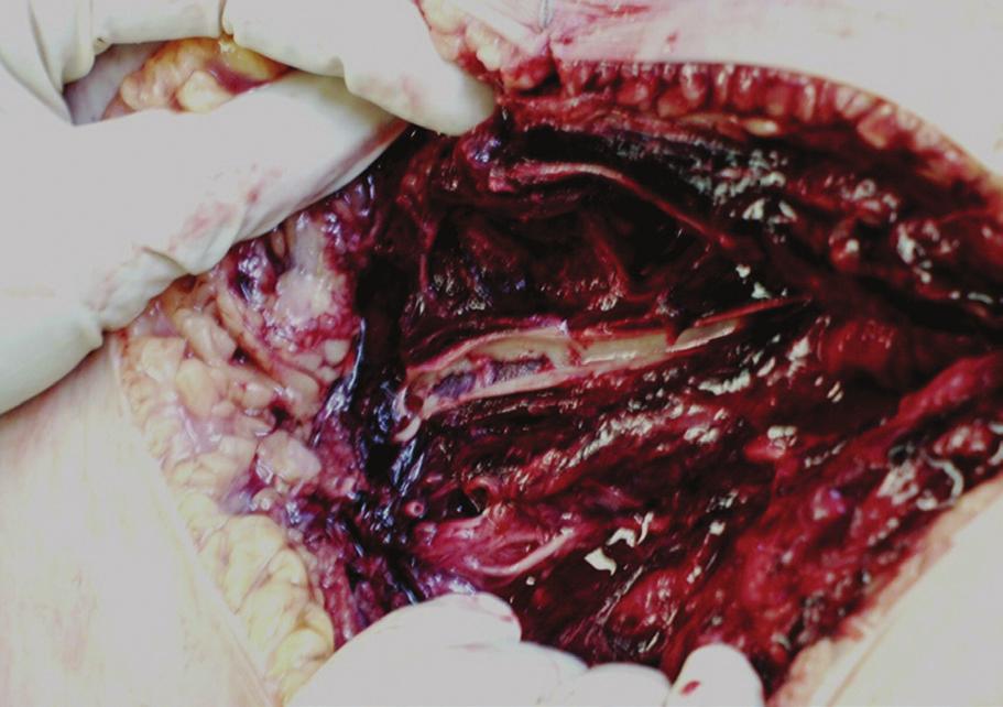 the femoral vessels or rapid sternotomy with central cannulation.