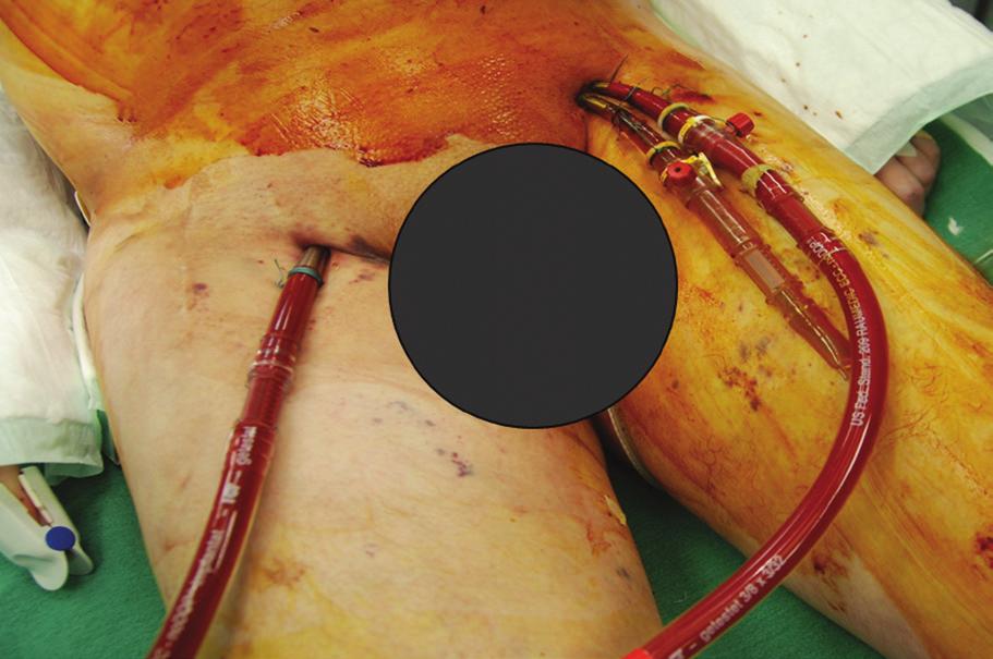 typically preclude a central cannulation under emergency conditions. Vessel laceration. Perforation of a vessel is a serious complication, which can ensue considerable local bleeding.