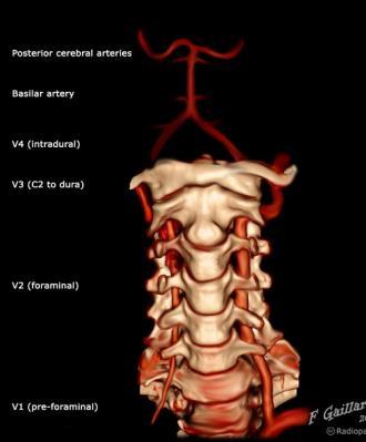 Vertebral artery (VA) dissection Headache or neck pain following a minor head or neck injury.