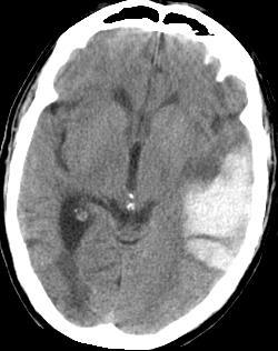 Cerebral Amyloid Angiopathy