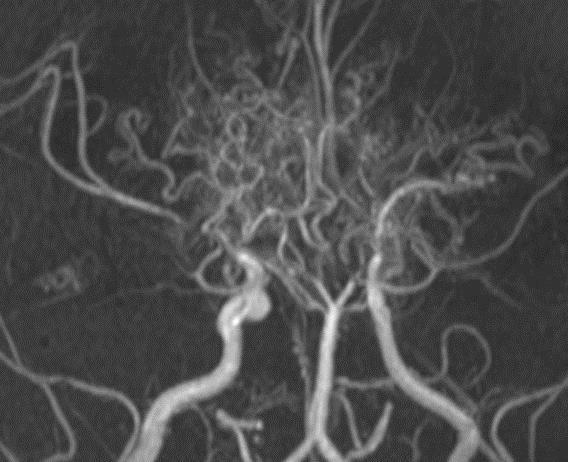 Moyamoya Disease A rare, progressive cerebrovascular disorder caused by blocked arteries at the base of the brain.
