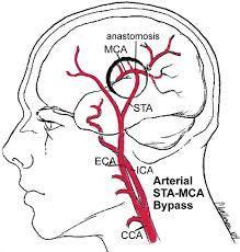 Revascularization surgery: Direct superficial temporal artery to middle cerebral