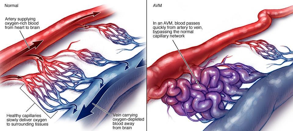 Arteriovenous Malformation (AVM) A tangle of abnormal blood