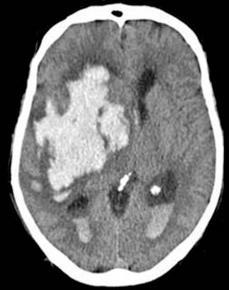 patients 20-50 years old Present with hemorrhage, seizure,
