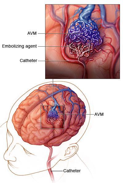 Treatment of Arteriovenous Malformation (AVM) Medical therapy Treatment of headache, HTN, and seizure Surgical resection If the AVM has bled or is in an area that can easily be reached, surgical
