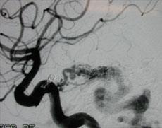 Dural Arteriovenous Fistula An abnormal connection (fistula) between an artery and a vein within the dura (the fibrous cover of the