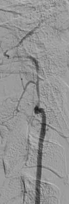 artery dissection at V 3 segment (A and