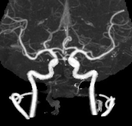 Locked-in from Acute Basilar Artery Occlusion