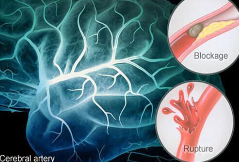 Stroke A stroke occurs when a brain vessel occludes or ruptures. Ischemic stroke: Cerebral infarction from lack of oxygen due to blockage of blood supply.