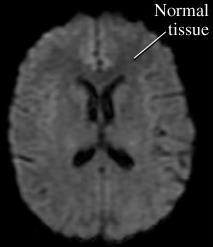 Tissue-based definition: A transient episode of neurological dysfunction caused by focal ischemia
