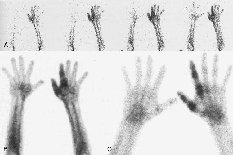 Diagnostic Tests: Three Phase Bone Scintigraphy Only in acute stage During the first year Scan is considered positive if flow is asymmetric in scan 1, 2, and/or 3 Increased blood flow to the