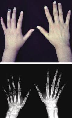 Diagnostic Tests: Plain Radiographs During Stage 1 of CRPS: Normal x-rays Late findings only with atrophic stage showing