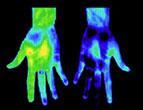 Diagnostic Tests: Skin Temperature Thermography may show asymmetry.