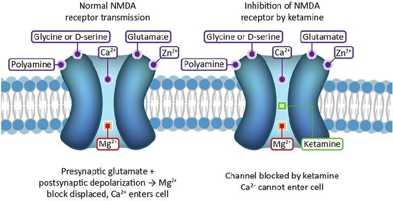 Treatment: Ketamine MOA: Non-competitive antagonist of the NMDA receptor Receptor channel needs to be open to enter and exert it s action Metabolism: Hepatic via hydroxylation and N-demethylation
