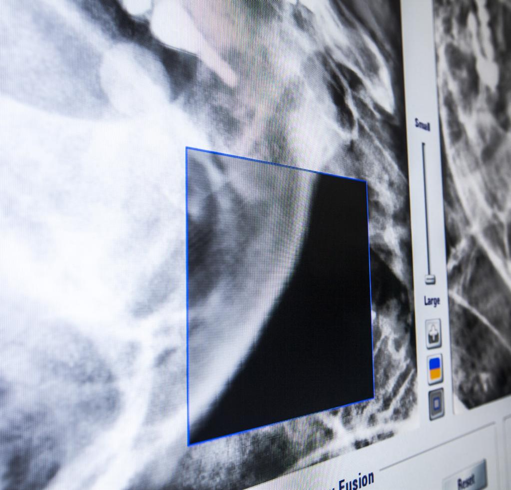PRECISION BASED ON INTERNAL ANATOMY ExacTrac X-Ray Monitoring provides clinicians with a unique insight into the patient position during treatment delivery.