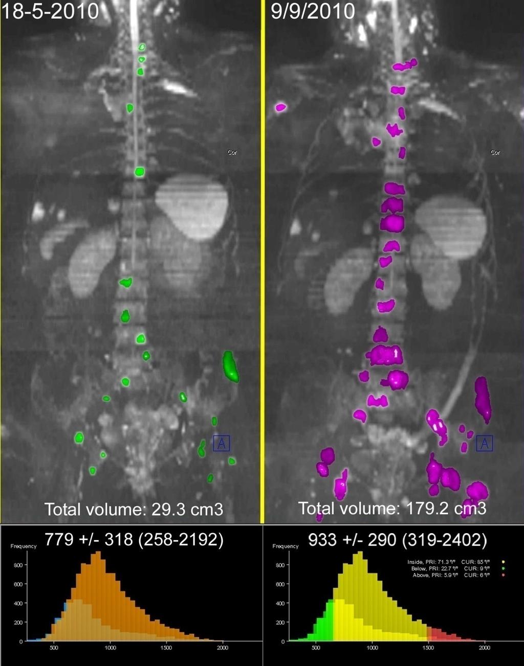 Increases in tumour volume & ADC values with progression 51 yo F metastatic breast cancer Bone and