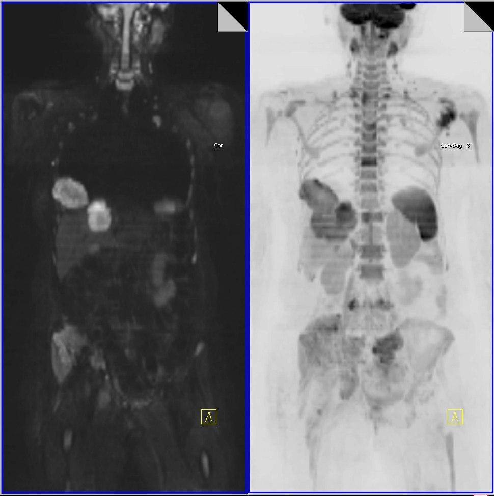 Whole body DWI for metastasis detection Widespread availability Better than CT scans and bone scans for lytic bony disease Also provides information about soft tissue disease Advantages No ionizing