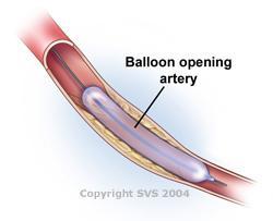 treated artery, and kidney problems. Additionally, blockages can develop in the arteries downstream from the plaque if plaque particles break free during the angioplasty procedure.