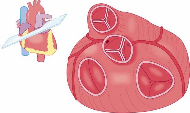 200 CARDIOVASCULAR SYSTEM, BLOOD, AND BLOOD CELL FORMATION Left atrium Aorta Coronary sinus Mitral valve Figure 7-3.