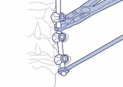 The appropriate rods are selected and contoured in order to match patient s deformity.