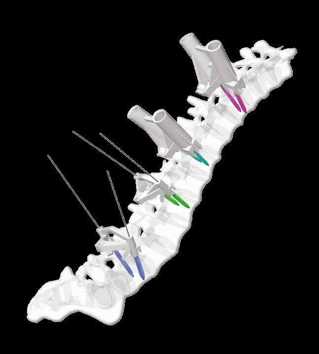 3.3 Why would my doctor choose a MySpine surgery MySpine is a patient-matched, 3D printed technology tailored to the patient s anatomy allowing to simplify pedicle screw placement.