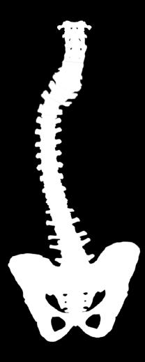 2. WHAT IS SCOLIOSIS Everyone s spine has natural curves.