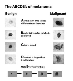 What to look for Warning signs ABCDE Encourage patients to know their skin More than 100 moles greater risk of melanoma New or changing moles should be
