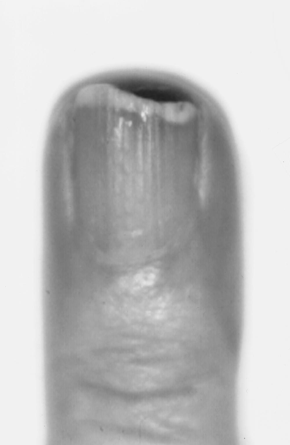 Patient 1 A 66-year-old woman presented with a pigmented lesion on the tip of her right fourth finger. The lesion had been present for 1 year. The biopsy specimen demonstrated a 1.