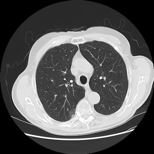 Mr. H: Multiple Nodules on Non-contrast Chest CT 2mm